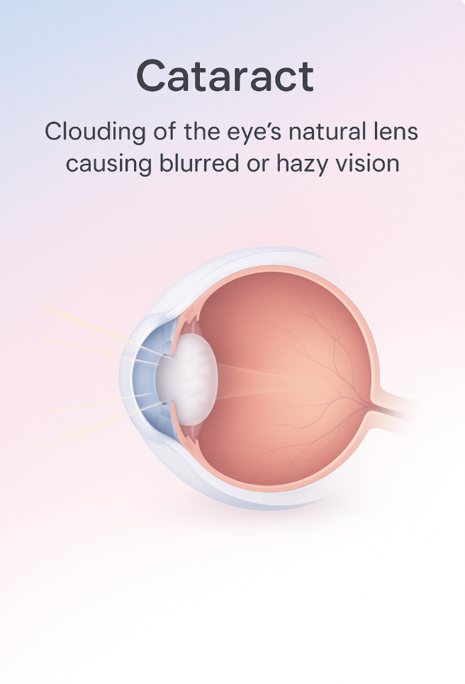 How a cataract clouds vision